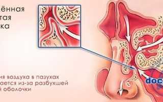 Катаральный гайморит — причины, виды, симптомы и лечение