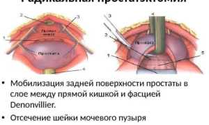 Простатэктомия: показания, процедура и реабилитация