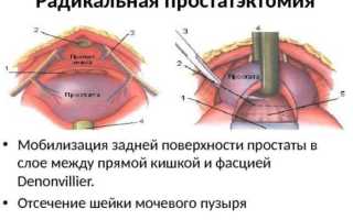 Простатэктомия: показания, процедура и реабилитация