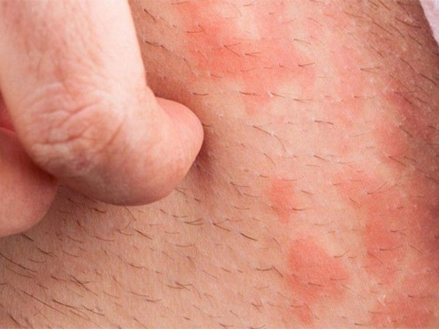 Покраснение кожи