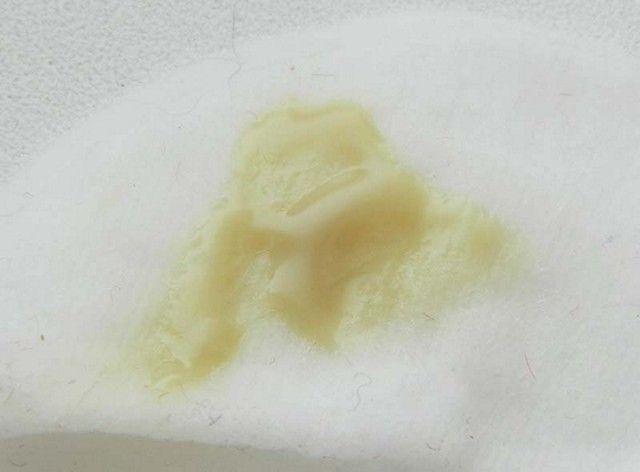 Зеленые выделения