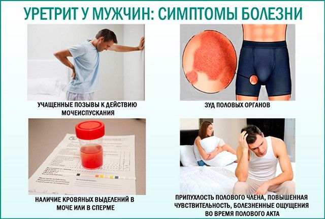 Симптомы уретрита