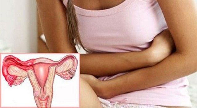 Воспаление придатков