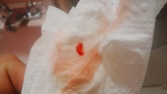 Выделения с кровью